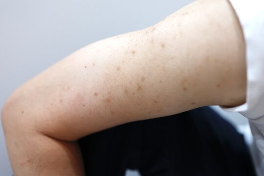 腕の色素沈着。茶色い斑点のクローズアップ。