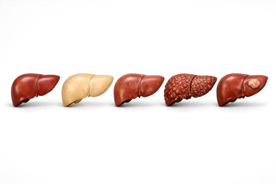Photorealistic 3D medical infographic with readable English text titled &ldquo;Stages of liver disease&rdquo;. A clean left-to-right progression of five realistic human liver 3D models arranged on one baseline