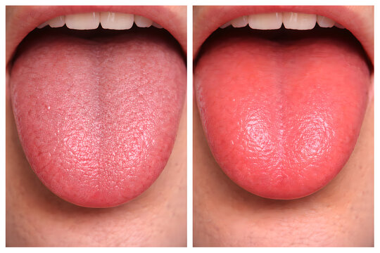 Photorealistic 3D medical referencing the sample: showing oral signs related to micronutrient deficiency Cheilosis, Glossitis (smooth erythematous tongue with reduced papillae), Bleeding, spongy gums