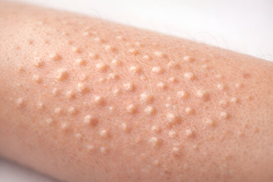 Photorealistic 3D medical infographic showing skin signs associated with micronutrient deficiencies: Xerosis, Follicular hyperkeratosis, Petechiae, Ecchymoses