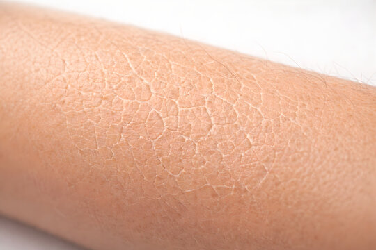 Photorealistic 3D medical infographic showing skin signs associated with micronutrient deficiencies: Xerosis, Follicular hyperkeratosis, Petechiae, Ecchymoses