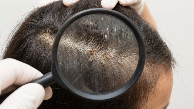 Gloved hands inspect scalp with magnifying glass, close view of hair and dandruff flakes, clinical hygiene check for dermatology and lice screening, health awareness