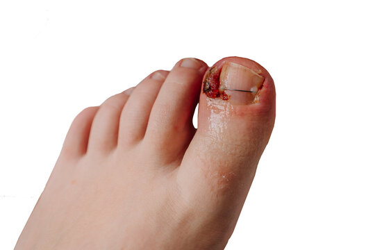 Ingrown toenail on a foot with a nail brace, showcasing redness and swelling around the affected area, isolated on a white background
