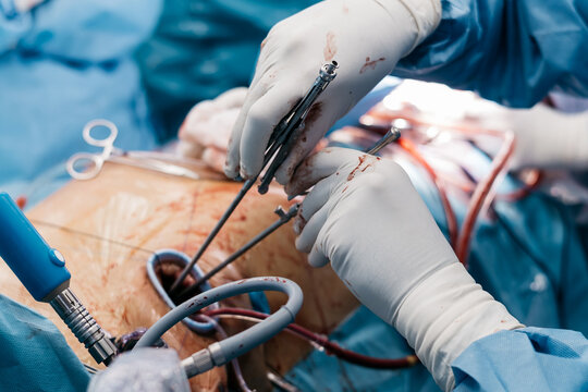 Cardiac surgery close up with medical instruments and operating lights. High-tech healthcare concept.