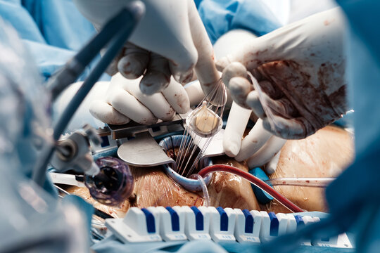 Open chest view during coronary artery bypass grafting (CABG). Exposed surgical field showing active cardiothoracic operation in a modern hospital.