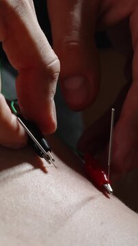Detailed close-up of electroacupuncture therapy with fine needles inserted into skin and linked to red and black alligator clips, hands position wires for electrical stimulation