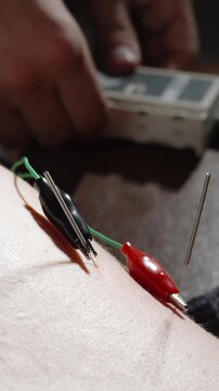 Close-up of electroacupuncture therapy showing stainless steel needles connected to red and black electrode clips on skin, with a practitioner adjusting a portable stimulation device during a pain