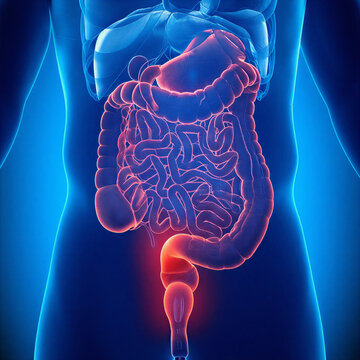 Anatomical illustration of the human colon and rectum highlighted in red, representing a medical condition or inflammation