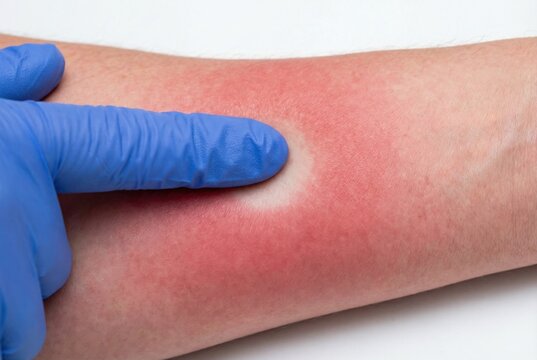 Medical test for blanching erythema on inflamed skin forearm