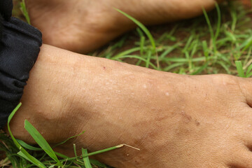 Close-up of a child's feet on grassy ground, showing dry skin texture and signs of mild skin infection or eczema