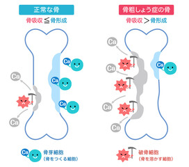 骨吸収と骨形成のしくみ　正常な骨と骨粗しょう症の骨
