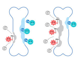 骨吸収と骨形成のしくみ　正常な骨と骨粗しょう症の骨