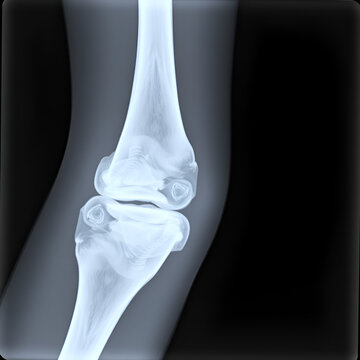 x ray of a elbow dislocation
