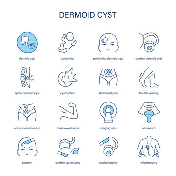 Dermoid Cyst symptoms, diagnostic and treatment vector icon set