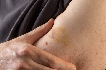 arm with bruises and bruises from a blow, the damaged part of a man's arm with red-yellow bruises and healing scratches