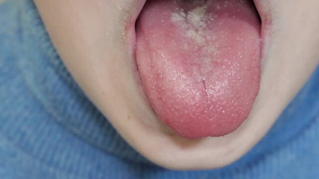 a child shows scarlet fever disease on the tongue, pain on the tongue, the tongue is covered with stitches and a white coating