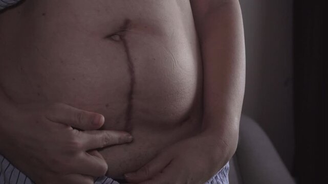 Medical examination of a scar following cancer treatment.