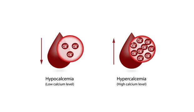 Hypercalcemia, high plasma calcium level and hypocalcemia, low plasma calcium level. Calcium excess and deficit electrolyte disorders. Scientific design. Vector illustration.