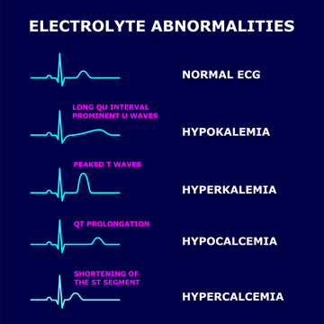 Electrolyte Abnormalities in ECG &ndash; hypokalemia, hyperkalemia, hypocalcemia and hypercalcemia. Medical vector illustration. ECG changes. Educational cardiology diagram isolated on dark blue background