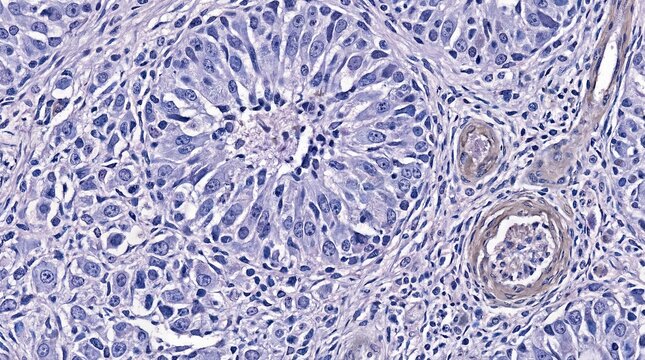 Glioblastoma multiforme tissue with irregular astrocytic cells