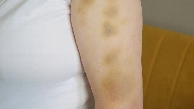 Examined Arm Injuries, Detailed View Of Bruised Arm, Focus On Upper Arm With Visible Injury Marks, Highresolution Photograph Displaying Injured Skin With Colorful Ecchymosis And Textural Details