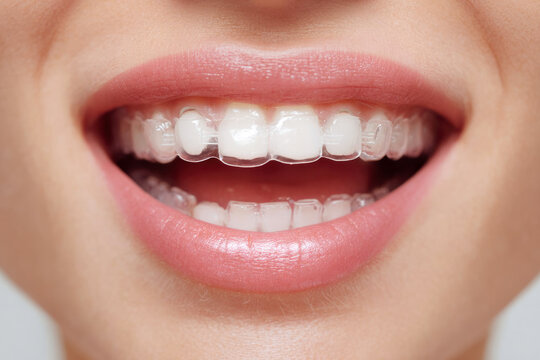 Close-up of a smiling female with clear dental aligners showcasing healthy teeth and lips, highlighting oral care and orthodontic treatment in a bright, neutral background