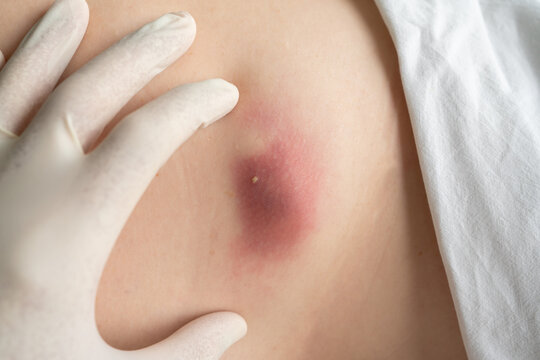 Dermatologist examining patient's inflamed boil filled with pus at hospital, closeup