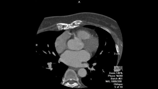 Three-dimensional coronary CT angiography demonstrating calcified atherosclerotic plaque at the left main bifurcation extending to the LAD, LCX, and ramus branches, relevant for cardiovascular imaging