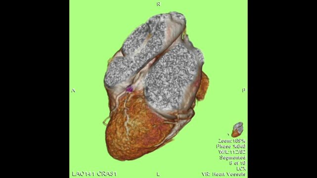 Three-dimensional coronary CT angiography demonstrating calcified atherosclerotic plaque at the left main bifurcation extending to the LAD, LCX, and ramus branches, relevant for cardiovascular imaging