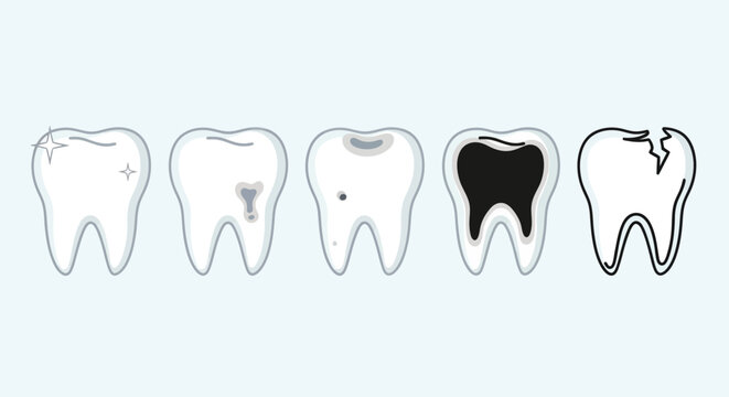Dental Health Icon Set Showing Stages of Tooth Decay Cavities and Broken Tooth Anatomy