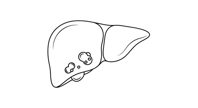 Human Liver Anatomy with Tumors, Medical Illustration