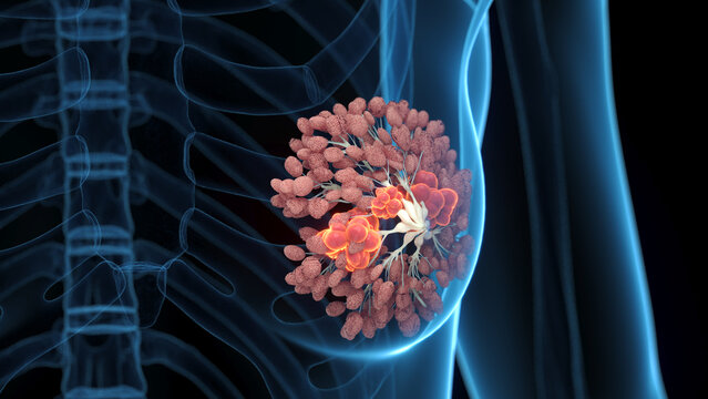 Accurate 3D Visualization Of Breast Cancer In A Human Female Highlighted In Full Depiction