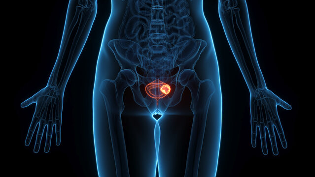 A Detailed 3D Depiction Of Bladder Cancer In A Woman