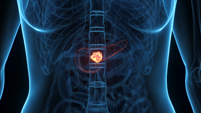 A Detailed 3D Depiction Of Pancreatic Cancer In A Woman