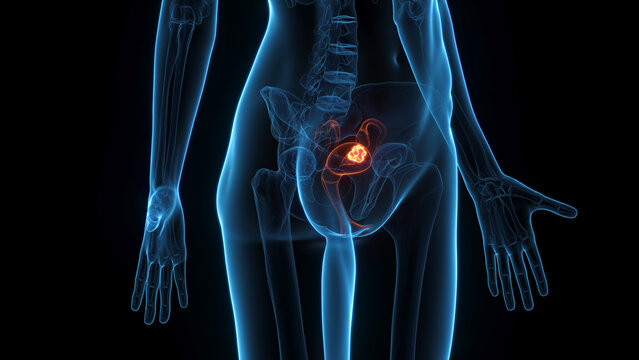 A Detailed 3D Depiction Of Uterine Cancer In An Adult Woman