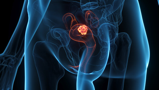 A Detailed 3D Depiction Of Uterine Cancer In An Adult Woman