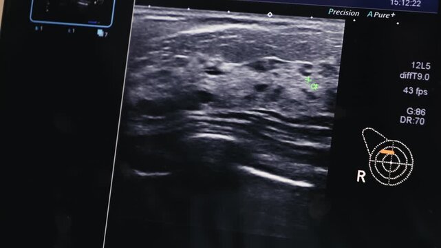 Breast ultrasound, mammogram image on screen in the doctor's office. Health concept and check up examination. High quality 4k footage