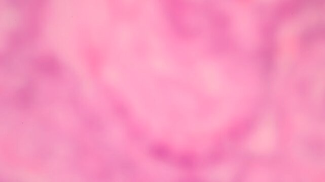 View in microscopic of ductal cell carcinoma, adenonocarcinoma from human breast cancer, tissue section by H and E stain.Pathology diagnosis.Medical concept. Under microscope, magnification 600X