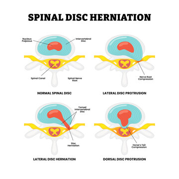 Different type of spinal disc herniation types. Labeled normal, lateral disc protrusion, herniation, dorsal disc. Spinal disc anatomy structure. Slipped, ruptured, or prolapsed disc. Healthcare.