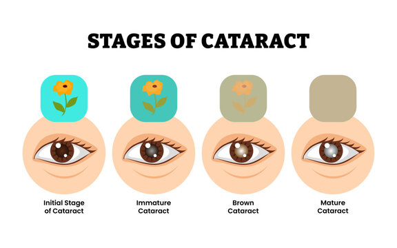 Stages of cataract stage process development. Eye disease infographic poster. Labeled initial, immature, brown and mature cataract with eye and Vision loss problem. Healthcare illustration vector.