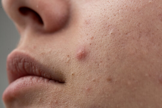 Pimple on skin with inflamed follicles. Skincare irritation for pimple with texture. Detail of pimple with whiteheads and pores. Dermatology macro of pimple on epidermis.