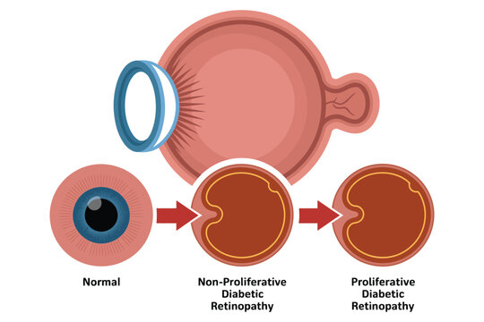 Illustration showing the progression of diabetic retinopathy affecting the eye's retina.