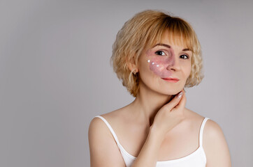 Woman with visible port-wine stain birthmark vascular skin condition with cream moisturizer dots on cheeks showing authentic skincare routine diversity inclusion self-care acceptance