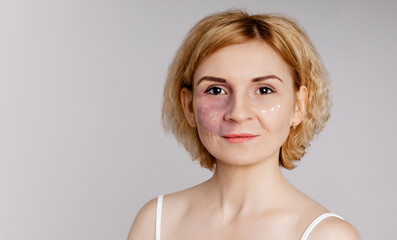 Woman with visible port-wine stain birthmark vascular skin condition with cream moisturizer dots on cheeks showing authentic skincare routine diversity inclusion self-care acceptance
