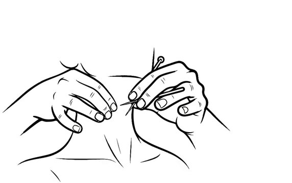 Close-up line drawing of hands holding tweezers to remove a splinter from skin