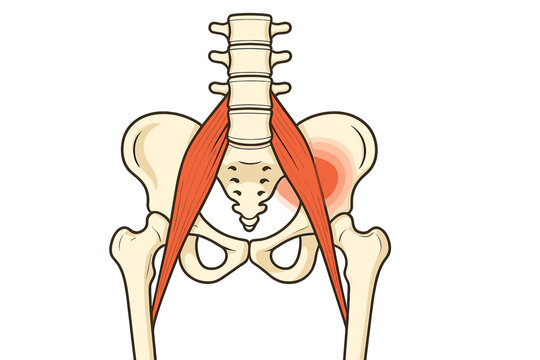 Medical illustration of the human pelvis and lumbar spine featuring the psoas major muscles. A red glow on the right hip indicates inflammation, strain, or localized pain.