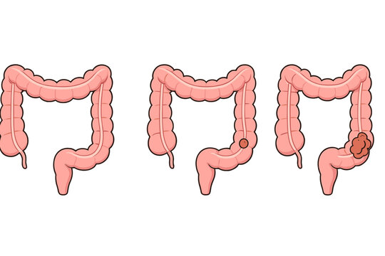 Three diagrams of the human large intestine illustrate the progression from a healthy state to the growth of a small polyp and a large malignant tumor in the colon.