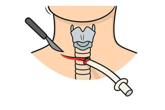 This medical illustration depicts a tracheostomy procedure on a human neck, showing a scalpel incision and the insertion of a breathing tube into the trachea for emergency airway management.