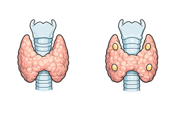 Medical illustration of the human thyroid gland and trachea. The right image shows the four parathyroid glands located on the posterior surface of the thyroid lobes against a black background.