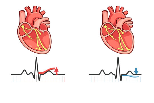 Medical illustration showing two human hearts with electrical conduction systems and corresponding electrocardiogram traces indicating ST-segment elevation and depression.